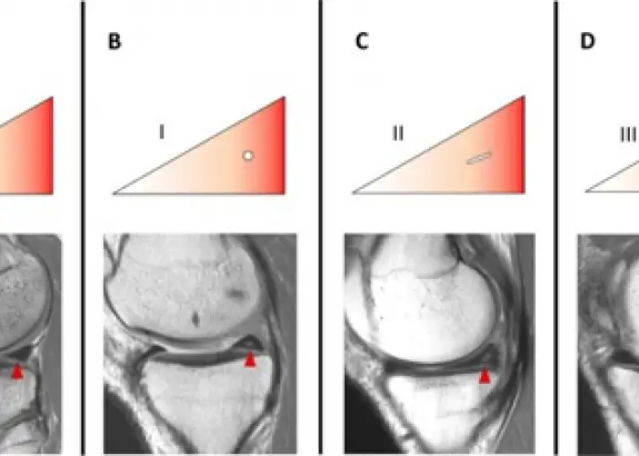 درجات اصابة الغضروف الهلالي للركبة